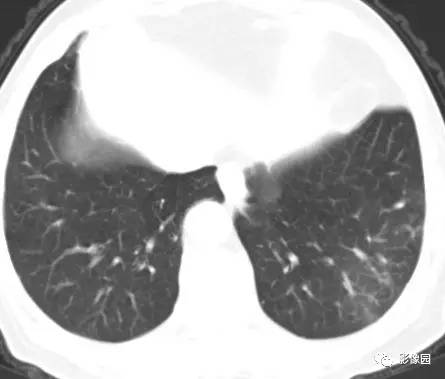 【病例】左下肺鳞癌1例CT