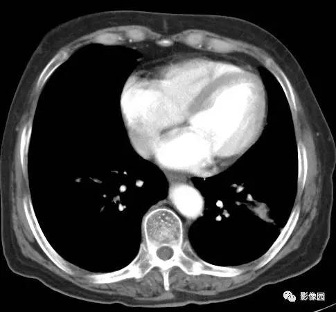 【病例】左下肺鳞癌1例CT