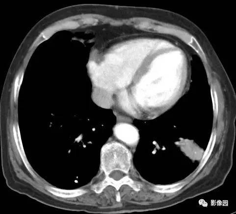 【病例】左下肺鳞癌1例CT