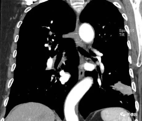 【病例】左下肺鳞癌1例CT