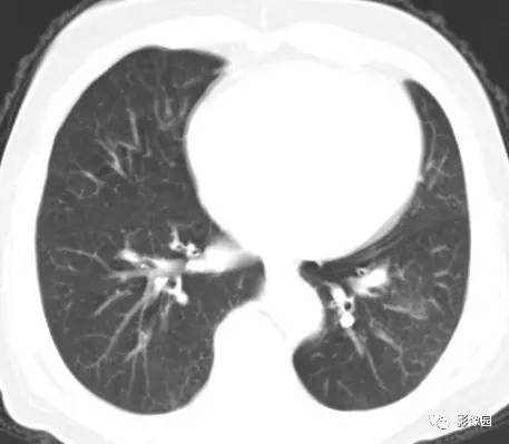 【病例】左下肺鳞癌1例CT