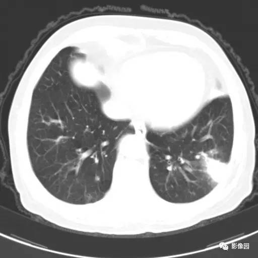 【病例】左下肺鳞癌1例CT