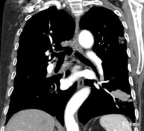 【病例】左下肺鳞癌1例CT