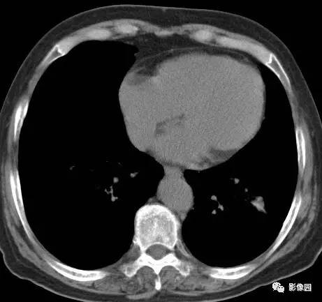 【病例】左下肺鳞癌1例CT