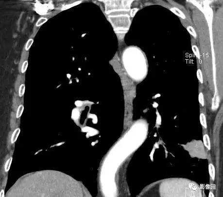 【病例】左下肺鳞癌1例CT