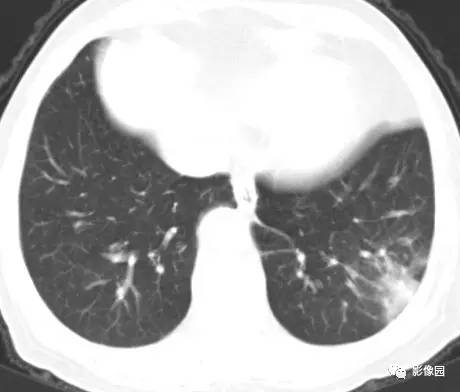 【病例】左下肺鳞癌1例CT