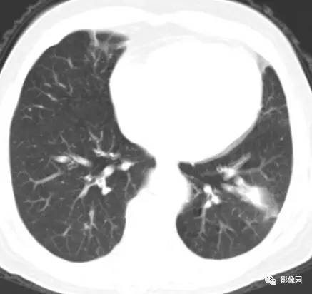 【病例】左下肺鳞癌1例CT
