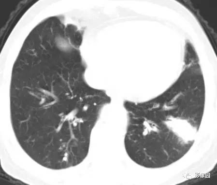 【病例】左下肺鳞癌1例CT
