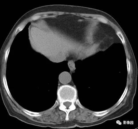 【病例】左下肺鳞癌1例CT