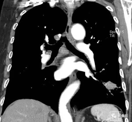 【病例】左下肺鳞癌1例CT