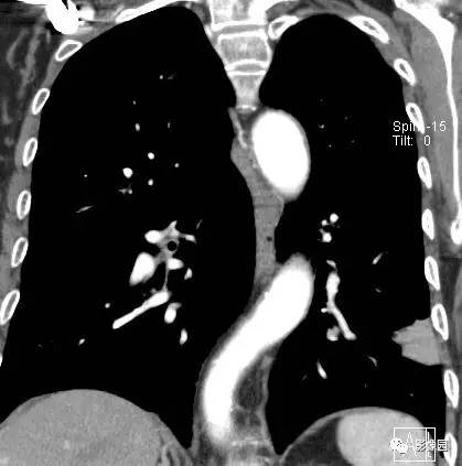 【病例】左下肺鳞癌1例CT