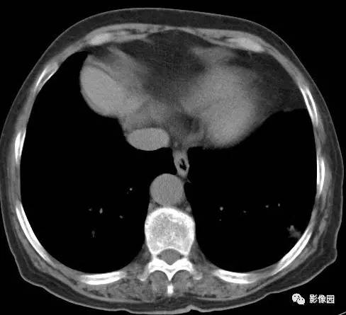 【病例】左下肺鳞癌1例CT