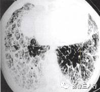 “铺路石征” 的影像表现与临床意义