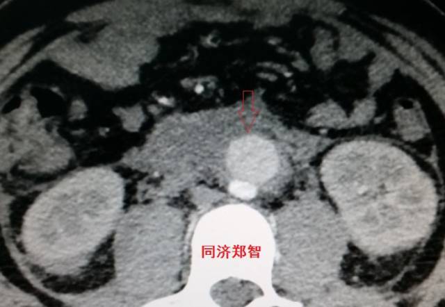 没有CTA？这三招也能识别主动脉夹层！