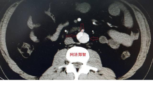 没有CTA？这三招也能识别主动脉夹层！