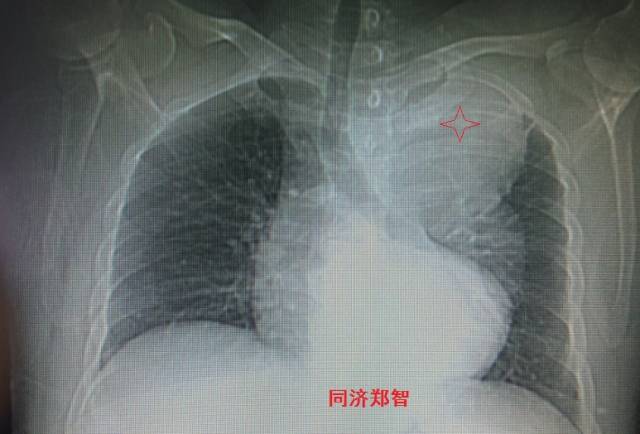 没有CTA？这三招也能识别主动脉夹层！