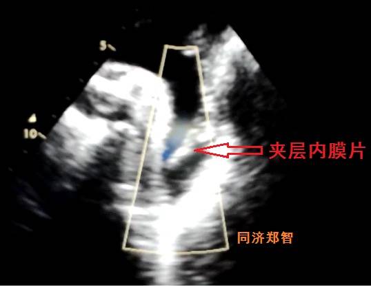 没有CTA？这三招也能识别主动脉夹层！