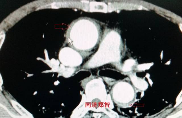 没有CTA？这三招也能识别主动脉夹层！