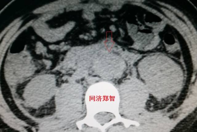 没有CTA？这三招也能识别主动脉夹层！