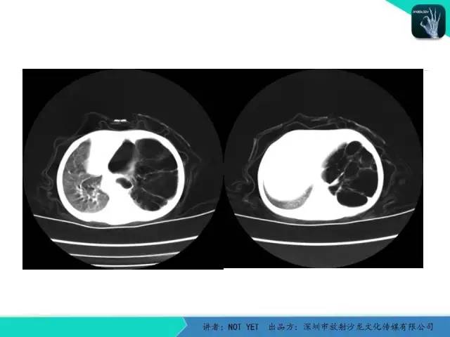 【病例】肺先天性囊性腺瘤样畸形1例CT