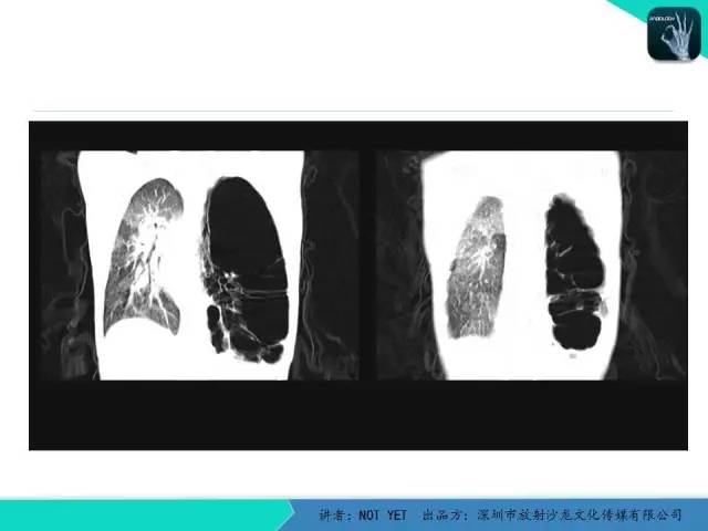【病例】肺先天性囊性腺瘤样畸形1例CT