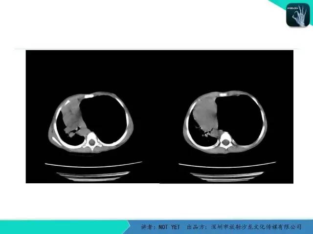 【病例】肺先天性囊性腺瘤样畸形1例CT