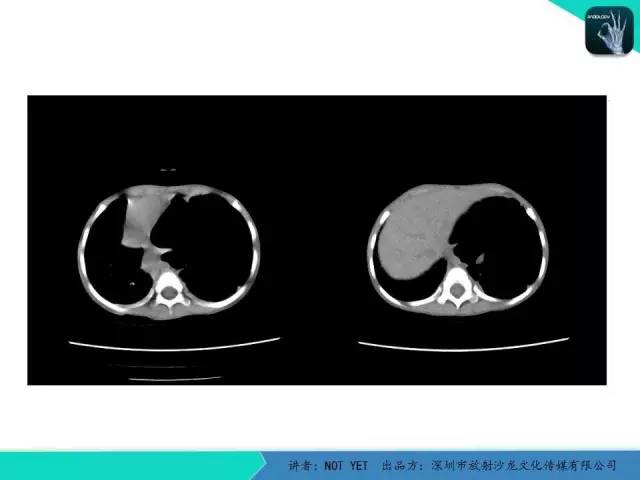 【病例】肺先天性囊性腺瘤样畸形1例CT
