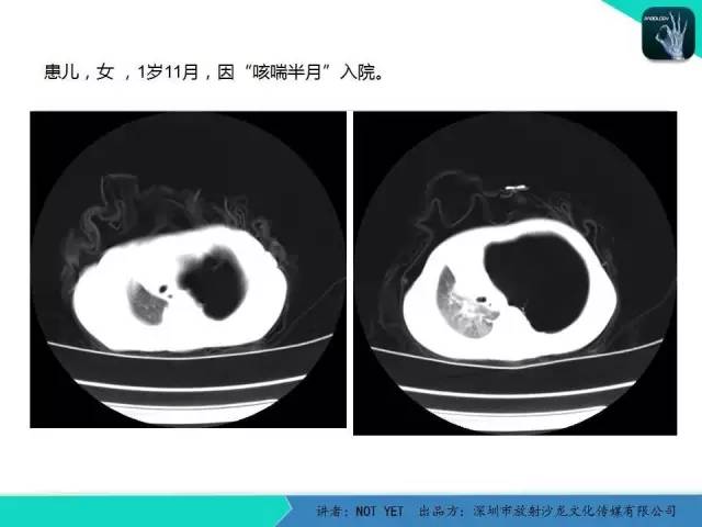 【病例】肺先天性囊性腺瘤样畸形1例CT