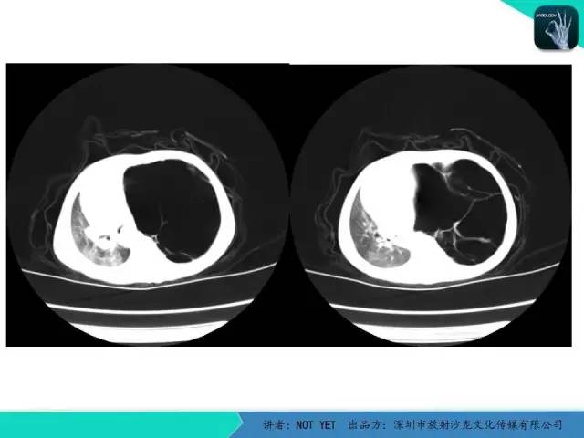 【病例】肺先天性囊性腺瘤样畸形1例CT