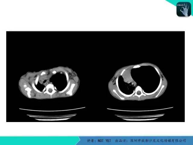 【病例】肺先天性囊性腺瘤样畸形1例CT