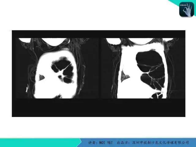 【病例】肺先天性囊性腺瘤样畸形1例CT