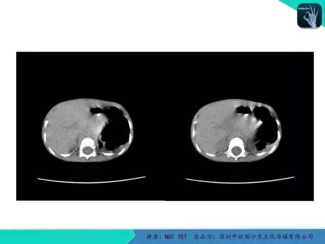【病例】肺先天性囊性腺瘤样畸形1例CT