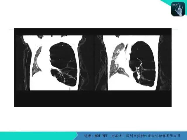 【病例】肺先天性囊性腺瘤样畸形1例CT