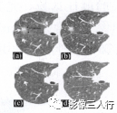 “磨玻璃征” 的影像表现与临床意义