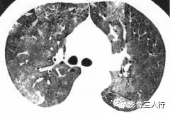 “磨玻璃征” 的影像表现与临床意义 “磨玻璃征” 的影像表现与临床意义