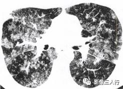 “磨玻璃征” 的影像表现与临床意义