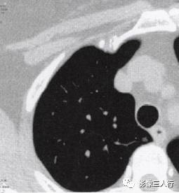 “磨玻璃征” 的影像表现与临床意义