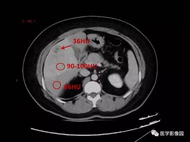 【病例】乳腺癌+肝脏神经内分泌肿瘤1例CT及MR