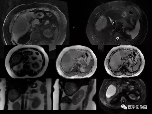 【病例】乳腺癌+肝脏神经内分泌肿瘤1例CT及MR