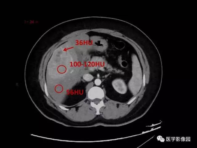 【病例】乳腺癌+肝脏神经内分泌肿瘤1例CT及MR