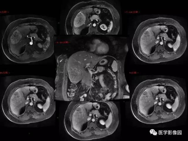 【病例】乳腺癌+肝脏神经内分泌肿瘤1例CT及MR