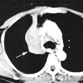 “逆S征” 的影像表现与临床意义