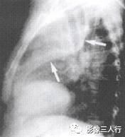 “逆S征” 的影像表现与临床意义