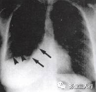 “逆S征” 的影像表现与临床意义