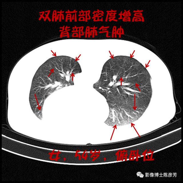二手烟的肺竟然是这样的 二手烟的肺竟然是这样的