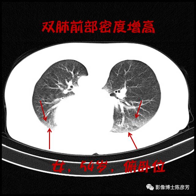 二手烟的肺竟然是这样的 二手烟的肺竟然是这样的