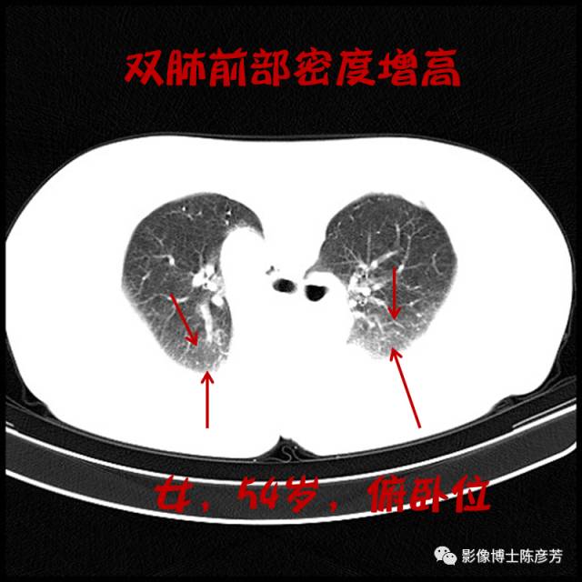 二手烟的肺竟然是这样的 二手烟的肺竟然是这样的