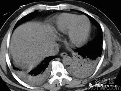 【病例】双侧胸腔积液并双下肺部分肺不张1例CT
