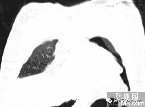 【病例】双侧胸腔积液并双下肺部分肺不张1例CT