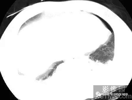 【病例】双侧胸腔积液并双下肺部分肺不张1例CT